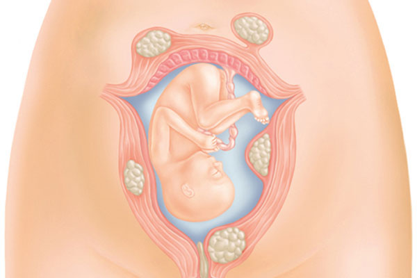 Миома матки и беременность: ведение беременности, осложнения, родоразрешение