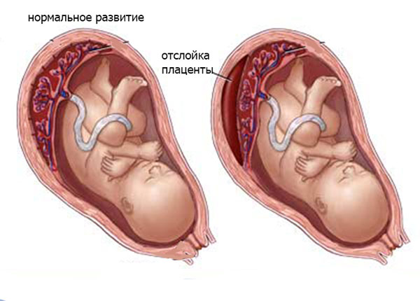Отслойка плаценты можно ли сохранить беременность
