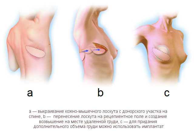 Схема реконструкции молочной железы с помощью кожно-мышечного лоскута