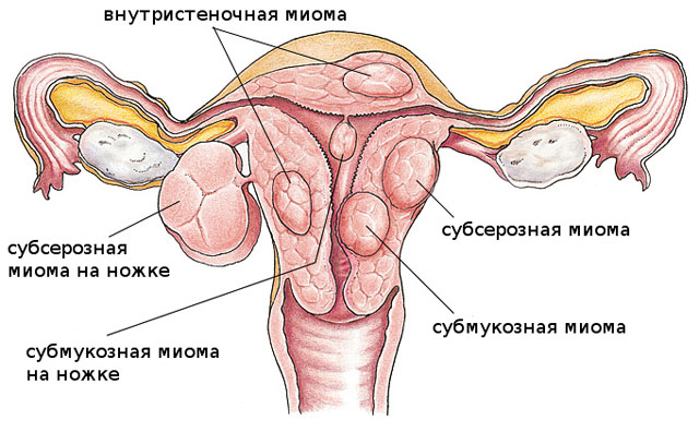 Классификация миомы матки