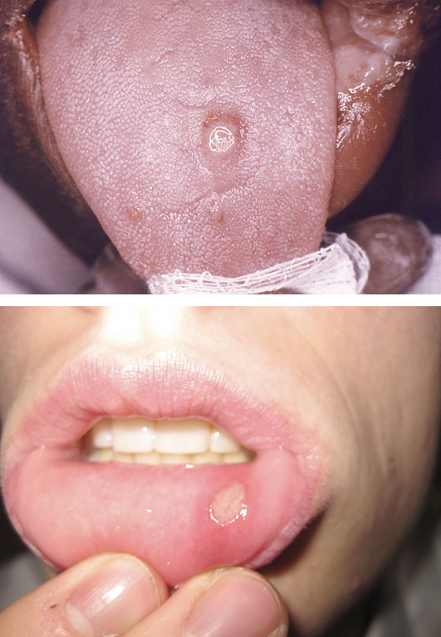первичный сифилис в полости рта