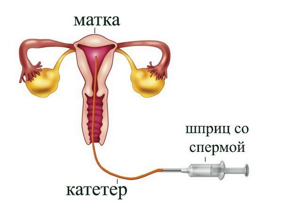 Впрыскивание спермы в матку 14