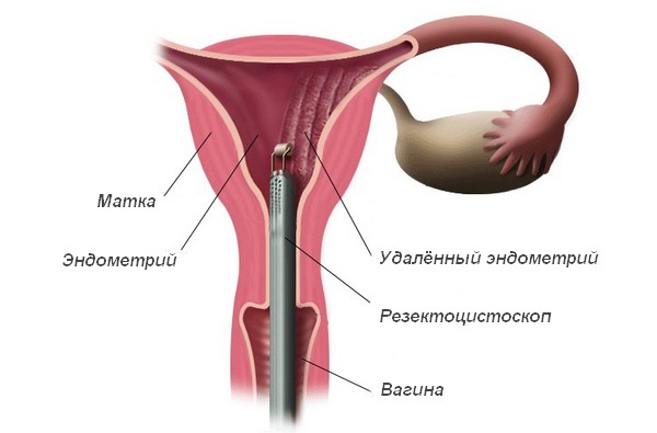 Как проводится абляция эндометрия