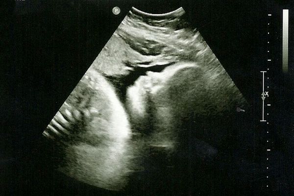 Нормы третьего узи при беременности 32 недели