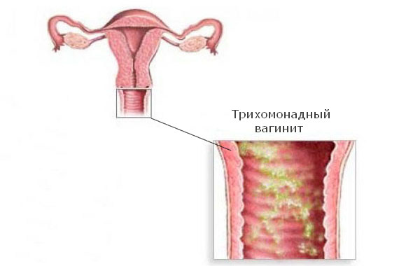 Трихомонадный вагинит