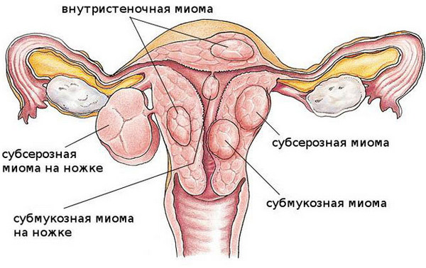 Родившийся узел миомы матки