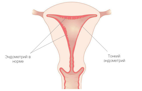 Как вылечить тонкий эндометрий матки thumbnail