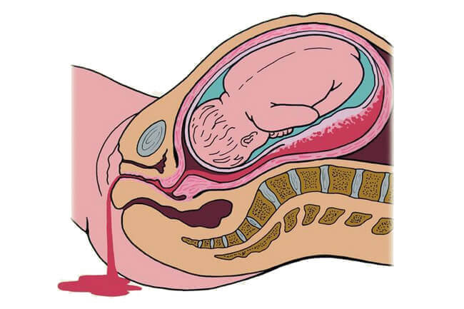 Что такое маточное кровотечение при родах