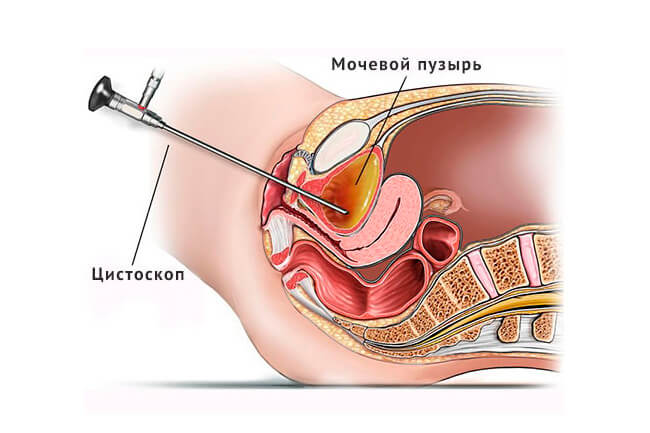 Цистэктомия при эндометриозе мочевого пузыря