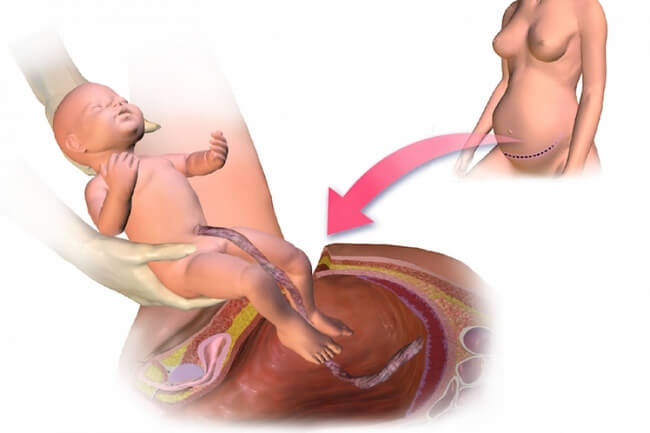 Особенности течения беременности и родов при миоме матки