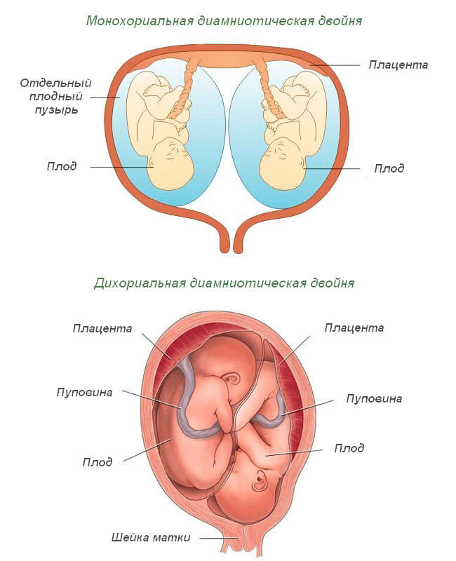 Монохориальная и дихориальная диамниотическая двойня