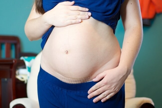 Ниша на рубце матки при беременности