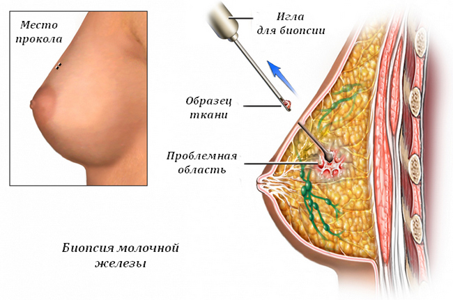 Проведение биопсии молочной железы